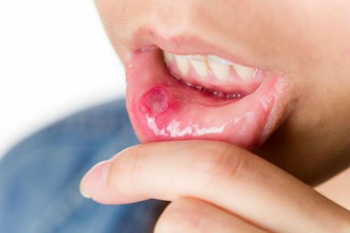 Диагностика по языку трещины. Грибковые, вирусные и бактериальные инфекции