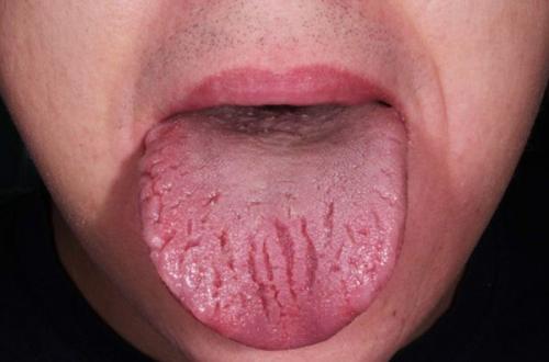 Диагностика заболеваний по языку. Дифференциация налета при гастрите от других заболеваний органов ЖКТ 01 Диагностика заболеваний по языку. Дифференциация налета при гастрите от других заболеваний органов ЖКТ 01