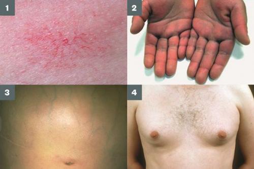 Лекарственное и токсическое поражение печени. Клинические рекомендации EASL по лекарственному поражению печени 2019 год 02 Лекарственное и токсическое поражение печени. Клинические рекомендации EASL по лекарственному поражению печени 2019 год 02