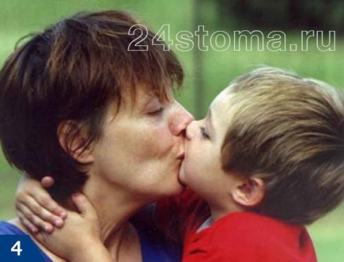 Как избавиться от герпеса в домашних условиях. Герпес на губах: причины возникновения