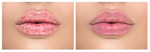 Как предотвратить появление герпетических болячек на губах. Симптомы герпеса разных типов 02