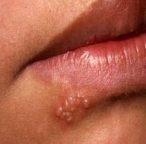 Как предотвратить появление герпетических болячек на губах. Симптомы герпеса разных типов