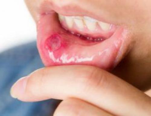 Клиническая картина и лечение при герпесе во рту. Как распознать герпес 08 Клиническая картина и лечение при герпесе во рту. Как распознать герпес 08