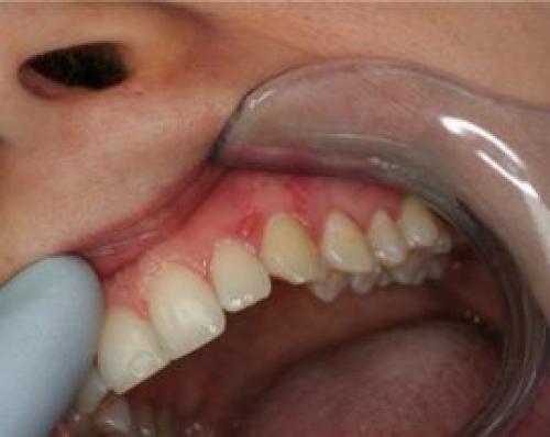 Клиническая картина и лечение при герпесе во рту. Как распознать герпес 09 Клиническая картина и лечение при герпесе во рту. Как распознать герпес 09