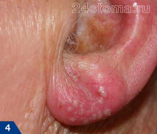 Как убрать герпес на губе за одну ночь. Герпес: фото