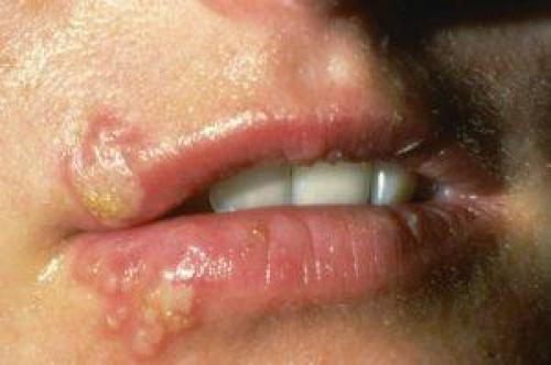 Герпес при беременности на губе чем лечить. Как лечить герпес