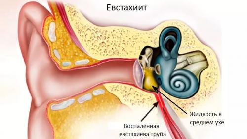 Почему болит ухо у взрослого: основные причины и методы лечения 01 Почему болит ухо у взрослого: основные причины и методы лечения 01