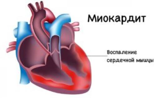 Вирус Коксаки комаровский. Как лечить вирус Коксаки у детей: советы доктора Комаровского