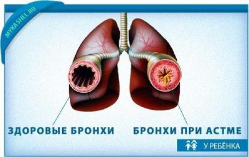 Кашель с мокротой без температуры. Причины, по которым возникает мокрый кашель у детей 03 Кашель с мокротой без температуры. Причины, по которым возникает мокрый кашель у детей 03