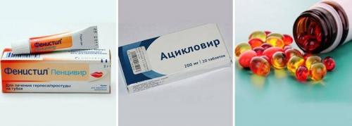 Как убрать герпес на губе за одну ночь. Как вылечить герпес на губах за 1 день в домашних условиях