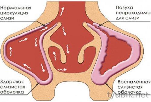 При насморке морская соль. Показания солевого раствора 03