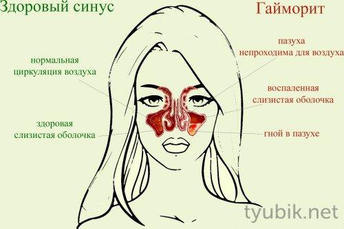 При насморке морская соль. Показания солевого раствора 01