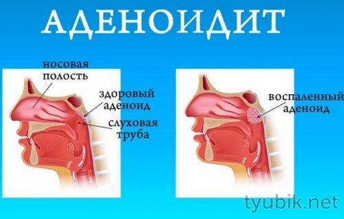 При насморке морская соль. Показания солевого раствора 02