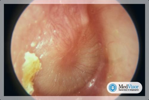 Застудил ухо, как лечить в домашних условиях. Продуло и стреляет в ухе: что делать и как лечить?