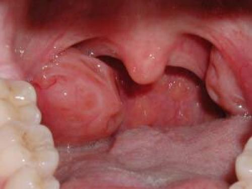 Болит ухо и горло с одной стороны, что делать. Причины одностороннего болевого синдрома