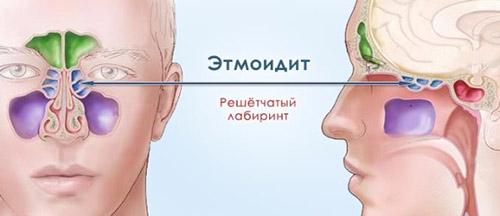 Хронический этмоидит мкб-10. Общие сведения