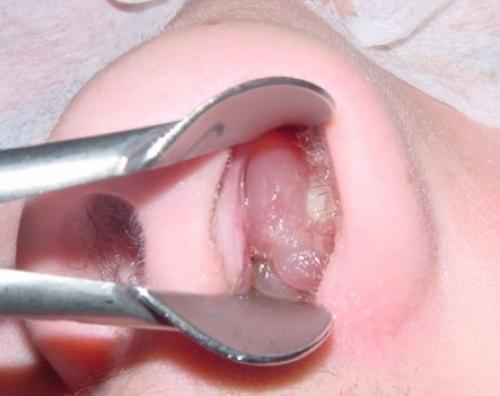 Желтые корки в носу лечение. Хронический ринит