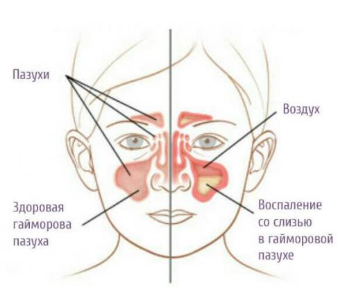 Чем лечить густые сопли у ребенка. Аллергическая реакция