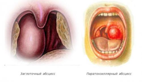 Сопли стекают по задней стенке глотки. Причины проблемы 03 Сопли стекают по задней стенке глотки. Причины проблемы 03