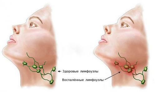 Сопли стекают по задней стенке глотки. Причины проблемы 04 Сопли стекают по задней стенке глотки. Причины проблемы 04