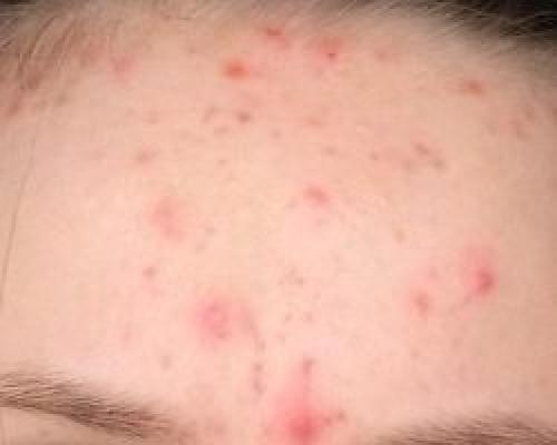 Как избавиться от прыщей на лице в домашних условиях подростку за 1 день.