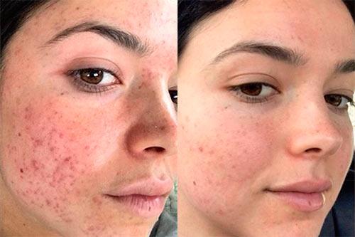 Как избавиться от прыщей на лице в домашних условиях подростку за 1 день.