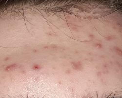 Как избавиться от прыщей на лице в домашних условиях подростку за 1 день.