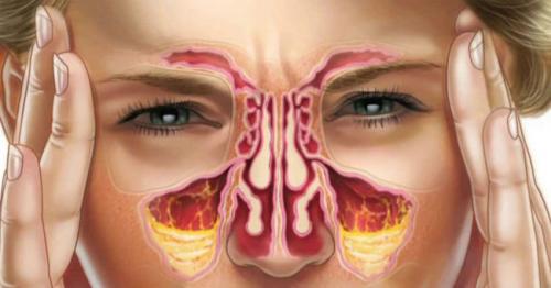 Какие домашние средства могут помочь облегчить постназальное стекание. 8 домашних средств для лечения постназального синдрома