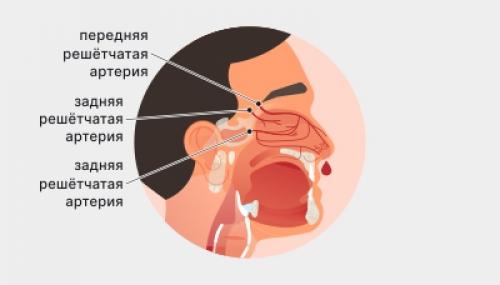 Почему у вас течь из носа, если не ОРВИ 05 Почему у вас течь из носа, если не ОРВИ 05