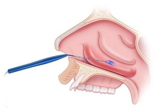 Как избавиться от заложенности в носу. Лечение симптома 05
