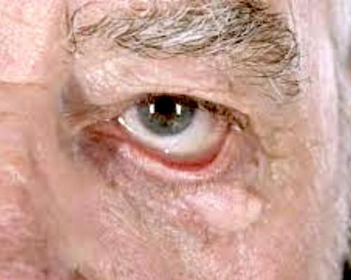 Слезятся глаза и насморк. Слезоточивость глаз и другие симптомы 02 Слезятся глаза и насморк. Слезоточивость глаз и другие симптомы 02