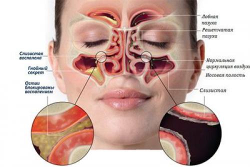 Как эффективно прочистить пазухи носа: проверенные способы 04 Как эффективно прочистить пазухи носа: проверенные способы 04
