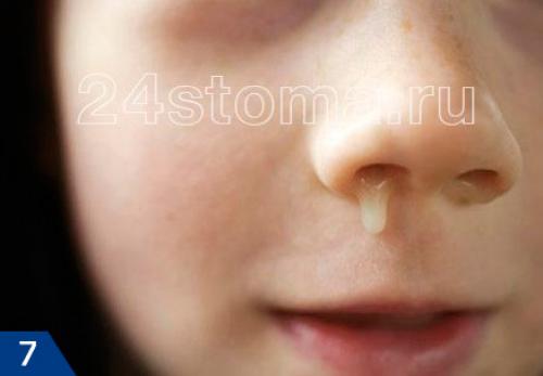 Как очистить носовые пазухи от гноя. Острый синусит –