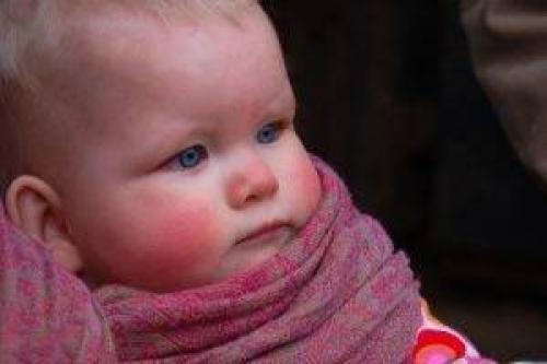 Может ли сильный насморк и кашель у ребёнка 6 месяцев быть признаком болезни