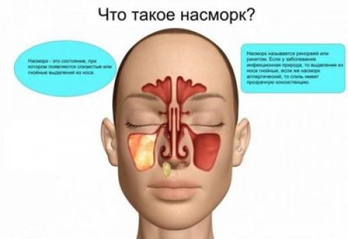 Бегут сопли как вода: как справиться с этим проблемом 03 Бегут сопли как вода: как справиться с этим проблемом 03