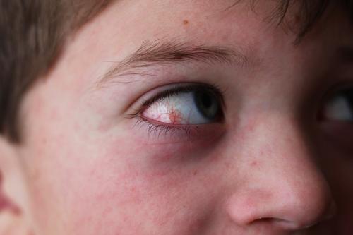 Как отличить сыпь при коксаки от других симптомов