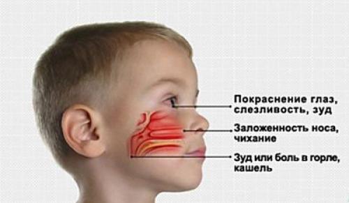 Физиологический ринит у новорожденного. Насморк у младенца: что такое физиологический ринит 03 Физиологический ринит у новорожденного. Насморк у младенца: что такое физиологический ринит 03