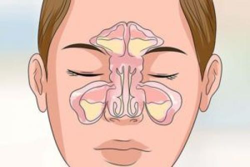 Катаральный гайморит и его характерные особенности. Патомеханизм и ключевые триггеры 01
