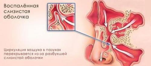 Катаральный гайморит и его характерные особенности. Патомеханизм и ключевые триггеры 06 Катаральный гайморит и его характерные особенности. Патомеханизм и ключевые триггеры 06