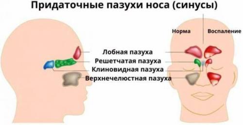 Различия между гайморитом и синуситом. Что такое гайморит 08 Различия между гайморитом и синуситом. Что такое гайморит 08