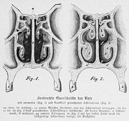В статье рассмотрена эмбриология носа и околоносовых пазух. Изменения состава микробиома полости носа при некоторых патологических состояниях 01