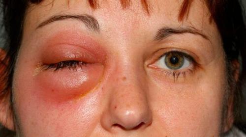 Связь лор-органов и глаз. Связь оториноларингологии с офтальмологией 03 Связь лор-органов и глаз. Связь оториноларингологии с офтальмологией 03