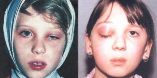 Связь лор-органов и глаз. Связь оториноларингологии с офтальмологией 02 Связь лор-органов и глаз. Связь оториноларингологии с офтальмологией 02