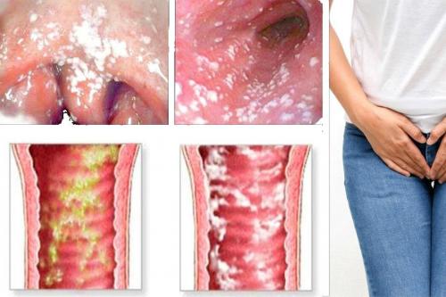 Противопротозойные препараты в гинекологии. Лечение инфекции влагалища