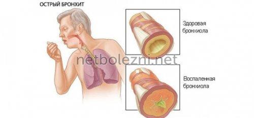 Антибиотики при бронхите для взрослых. Список топ-4 антибиотиков при бронхите по версии КП 02