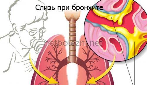 Антибиотики при бронхите для взрослых. Список топ-4 антибиотиков при бронхите по версии КП 01
