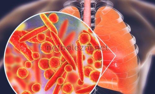 Антибиотики при бронхите для взрослых. Список топ-4 антибиотиков при бронхите по версии КП 03