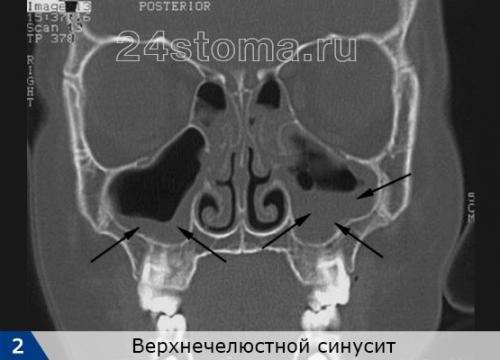 Острый синусит. Верхнечелюстной синусит: симптомы и лечение