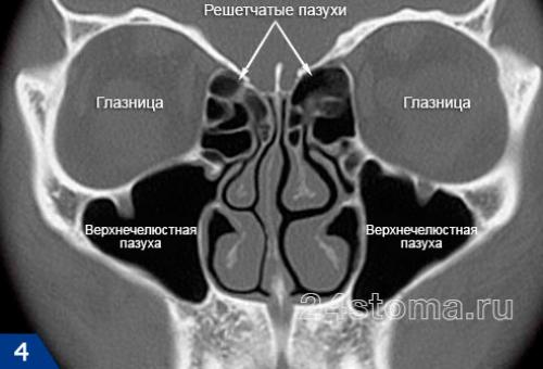 Острый синусит. Верхнечелюстной синусит: симптомы и лечение