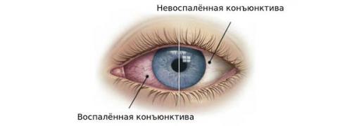 Насморк и конъюнктивит у ребенка при простуде. Как выявить природу заболевания? 04 Насморк и конъюнктивит у ребенка при простуде. Как выявить природу заболевания? 04